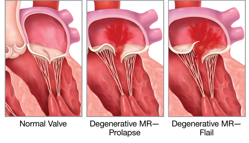 mitral-valve-stenosis-symptoms-treatment