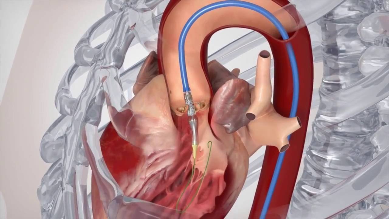 Is It Normal To Have Heart Valve Leakage